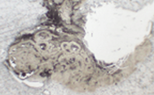 RNA extraction from FFPE tumor tissues